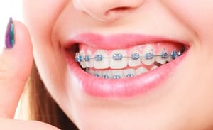 invisalign